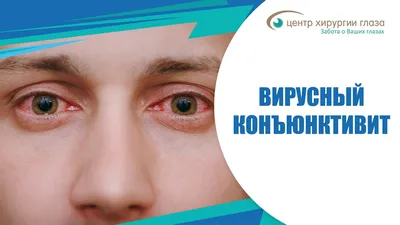 Лечение вирусного конъюнктивита | Центр Ока