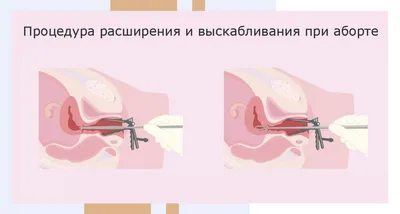 Медикаментозный аборт: что нужно знать о раннем прерывании беременности?