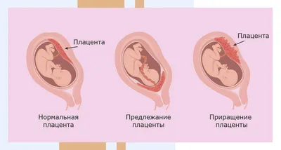 Информация об аборте - ГБУЗ \"Кущевская центральная районная больница\" МЗ КК