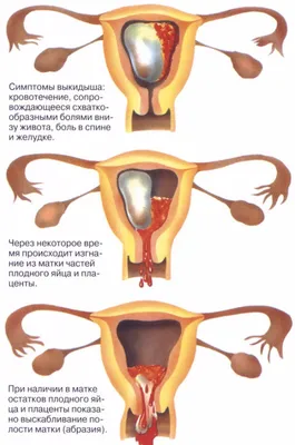 Аборт и его последствия • Пчела