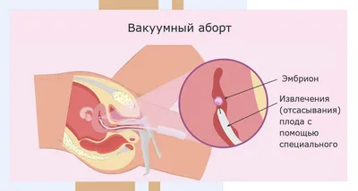 Таблетки Stada Миролют - «Аборт в 12,1 акушерскую неделю. Второй этап. Как  облегчить боль, ускорить процесс выхода плодного яйца. Советы.  Гистологический анализ плодного яйца.» | отзывы