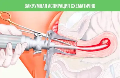 Остатки после медикаментозного аборта, выкидыша