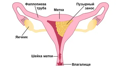 Вакуумный аборт: что это, как и на каких сроках делают мини-аборт, сколько  стоит, можно ли после него забеременеть