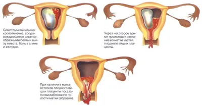 Вакуумная аспирация (чистка матки) при замершей беременности на раннем сроке