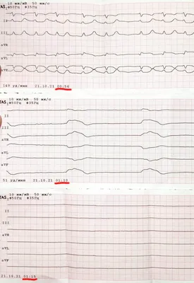 Плохая кардиограмма фото фото