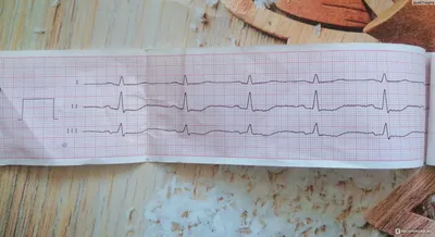 Плохая кардиограмма сердца фото фото