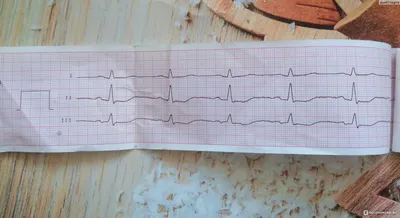 Электрокардиография (ЭКГ) - «Плохой результат ЭКГ - для меня уже норма.  Есть куда более информативное исследование. И вообще я знаю, как обмануть  прибор. » | отзывы