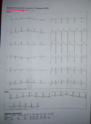 Расшифровка ЭКГ | Пикабу