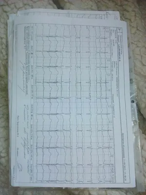 Плохая кардиограмма, перебои в работе сердца - Вопрос кардиологу - 03 Онлайн