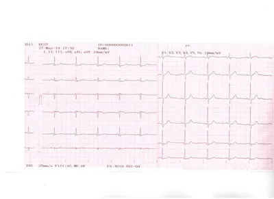 Пожалуйста, расшифруйте мои ЭКГ. | Консультация кардиолога в Минске на  DOKTORA.BY - ВРАЧИ БЕЛАРУСИ