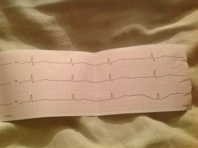 Жалоб вообще ни каких, но говорят кардиограмма плохая - Вопрос кардиологу -  03 Онлайн