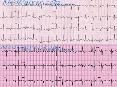 Особенности ЭКГ у беременных - презентация онлайн