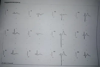 Расшифровка ЭКГ | Пикабу
