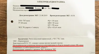 Электрокардиография (ЭКГ) - «Как оказалось не самое информативное  исследование! Мое плохое ЭКГ с детства и здоровое сердце.» | отзывы