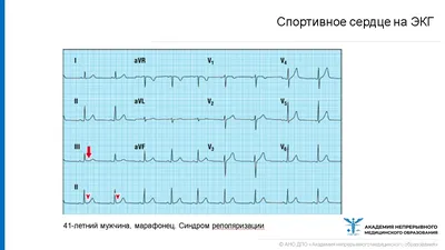 Физиологическое спортивное сердце. Основные изменения