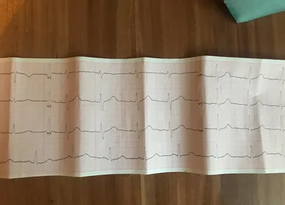 Расшифруйте пожалуйста кардиограмму. Сердце беспокоит редко, но кардиограмма  кажется плохая - Вопрос кардиологу - 03 Онлайн