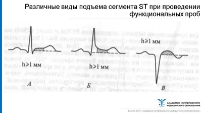 ПОЧЕМУ КАРДИОГРАММА ПЛОХАЯ, А УЗИ СЕРДЦЕ ХОРОШЕЕ | Кардиофлешка ECG Dongle  | Дзен