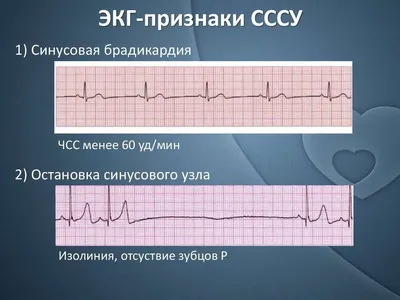 Ответы Mail.ru: Если к примеру, у человека плохая кардиограмма сердца ( ЭКГ)  то смогут ли его допустить к занятиям в бассейне?