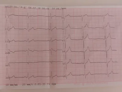 Плохое ЭКГ - Вопрос кардиологу - 03 Онлайн