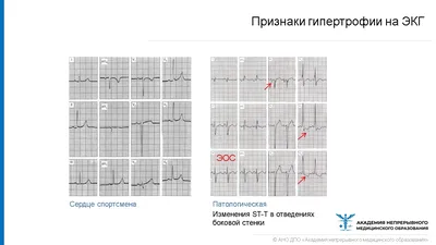 Что такое ЭКГ, какую информацию может показать - 29 сентября 2019 - 74.ru