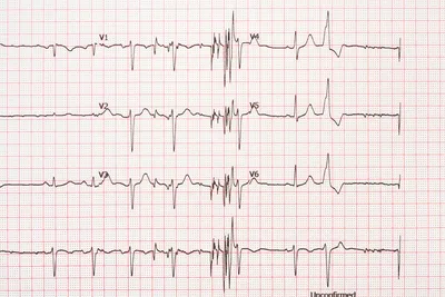Экстрасистолия - причины, симптомы, диагностика и лечение, прогноз