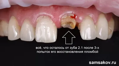 Как восстановить передний верхний зуб, если пломба выпадает – ортопед  Самсаков Сергей, Москва