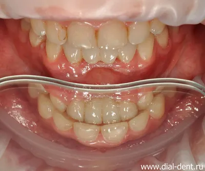 Реставрация передних зубов – замена старых пломб