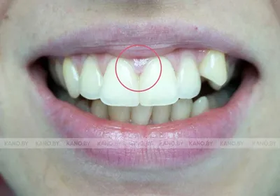 Терапия. Кейс №3. Замена старых пломб - примеры работ стоматологии KANO