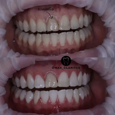 Керамические коронки для коррекции формы и цвета передних зубов
