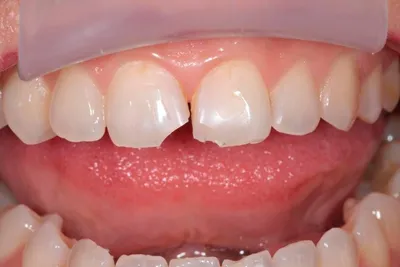 Можно ли делать отбеливание зубов с пломбами