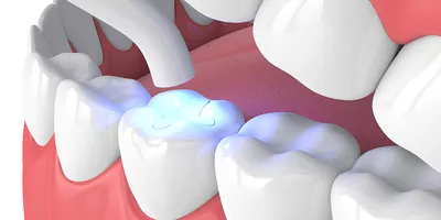 Домашняя стоматология Временная пломба для ремонта зубов виниры силиконовые