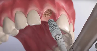Фотополимерная реставрация зуба, чем лучше пломбы | Стоматология  Дентал-центр Липинский