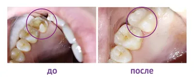 Художественная реставрация переднего зуба: методики, сколько стоит — WDR  «ВАЙДЕР» на Позняках