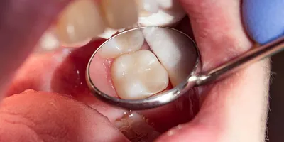 Пломбы На Зубы 5 Видов Какие Бывают Поставить ЛюмиДент