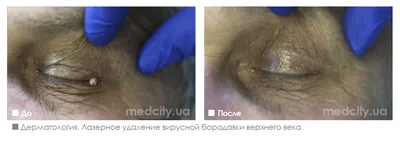 Удаление Родинок, Папиллом, Бородавок Запорожье Цены ⭐ Косметология  BeautyMed