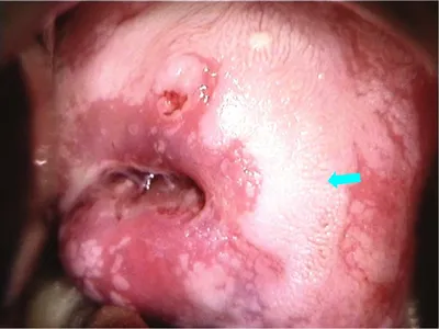 Atlas of visual inspection of the cervix with acetic acid for screening,  triage, and assessment for treatment