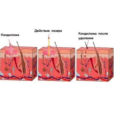 Удаление кондилом в Москве - Damas Medical Center