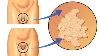 ВПЧ — вирус папилломы человека: симптомы и проявления, причины заражения,  лечение