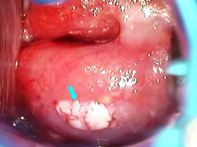 Atlas of visual inspection of the cervix with acetic acid for screening,  triage, and assessment for treatment