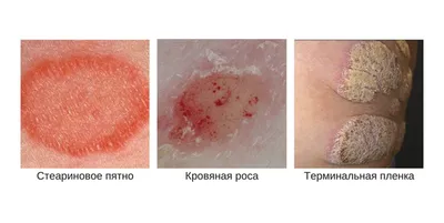 Красный плоский лишай (КПЛ) - воспалительный дерматоз с иммунным ответом,  характерезующиеся появлением папулезных высыпаний на коже и… | Instagram
