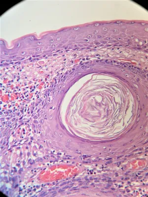 Первично множественные злокачественные опухоли кожи: меланома и  базальноклеточный рак - Гайдина - Вестник дерматологии и венерологии