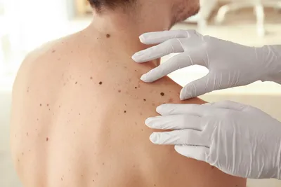 Плоскоклеточный рак кожи: лечение плоскоклеточной карциномы кожи,  дифференциальный диагноз, как выглядит, фото | Клиники «Евроонко»