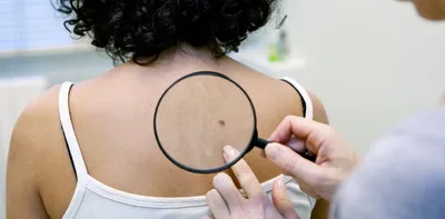 Плоскоклеточный рак кожи: симптомы и лечение эпителиомы в Одессе |  Медицинский дом Odrex