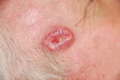 Плоскоклеточный рак кожи: стадии, симптомы, диагностика, методы лечения,  прогноз, выживаемость