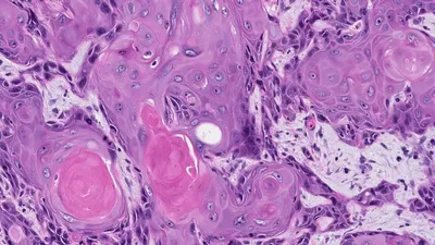 Актинический кератоз – предиктор развития первично-множественного  синхронного плоскоклеточного рака кожи: описание клинического наблюдения -  Седова - Альманах клинической медицины