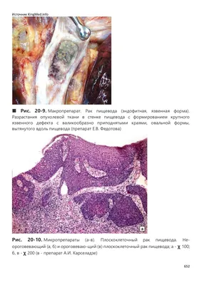 Плоскоклеточный рак кожи при пигментной ксеродерме