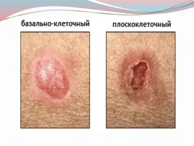 Плоскоклеточный рак кожи: фото, стадии развития - Фото болезней