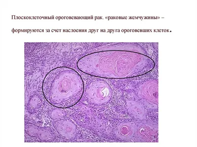 Клинико-морфологические особенности и лечение рака кожи, развившегос