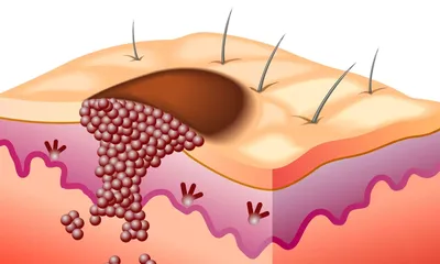 Немеланомный рак кожи: что это? | МЦ Лазерсвiт