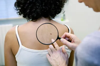 Рак кожи – причины, симптомы, диагностика и лечение у взрослых | «Будь  Здоров»